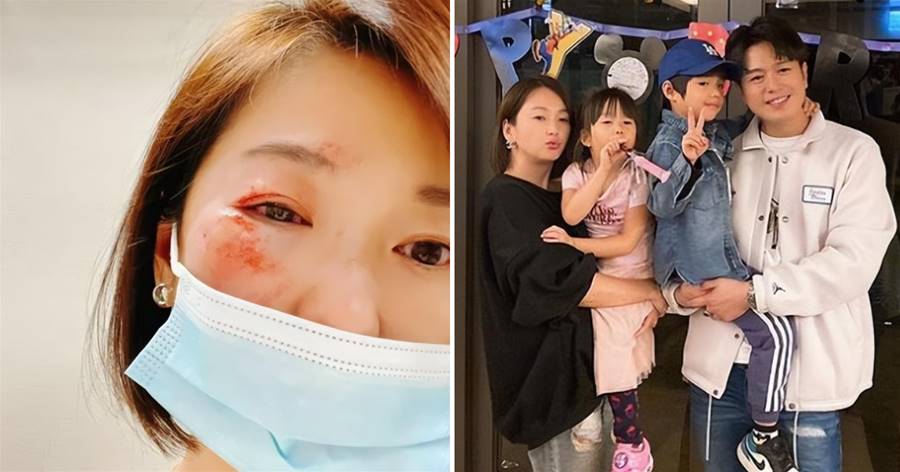 46歲女星自曝臉部受傷，姐弟戀結婚11年，被擔心遭上手收百條信息